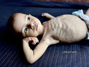 الجوع والألم يفترسان الطفلة وتين ندا