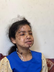 الطفلة ماريا قبل فقدان بصرها على يد جيش الاحتلال