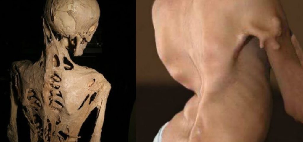 متلازمة الرجل الحجري