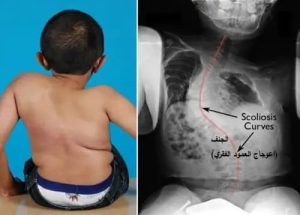 تشوهات العمود الفقري
