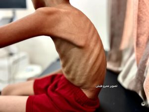 بينان.. جسد صغير أنهكته المجاعة