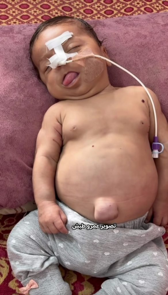 الطفلة جنة مطير تواجه الموت في غزة