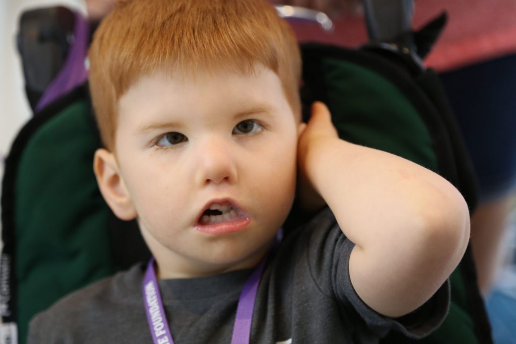 متلازمة موبيوس