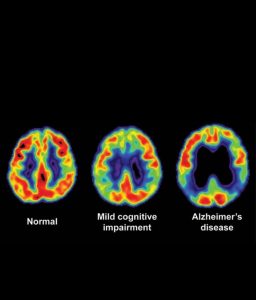 صورة توضح الفرق بين الدماغ السليم وتغير الخلايا العصبية وقت الإصابة بالزهايمر