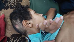 أن عدم استجابة جسده للطعام أدى إلى سوء تغذية حاد