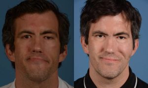 قبل وبعد عامين من عملية زرع عضلة الرقيقة واستبدال وزن الجفن العلوي في حالة موبيوس